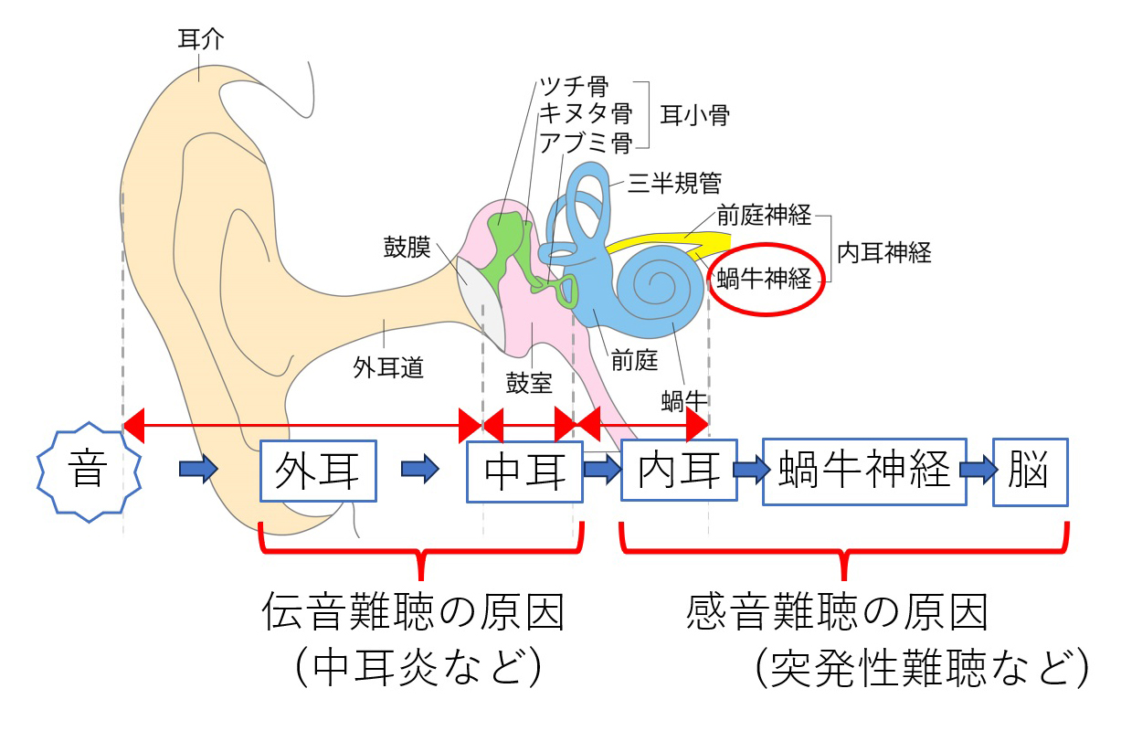 難聴の説明