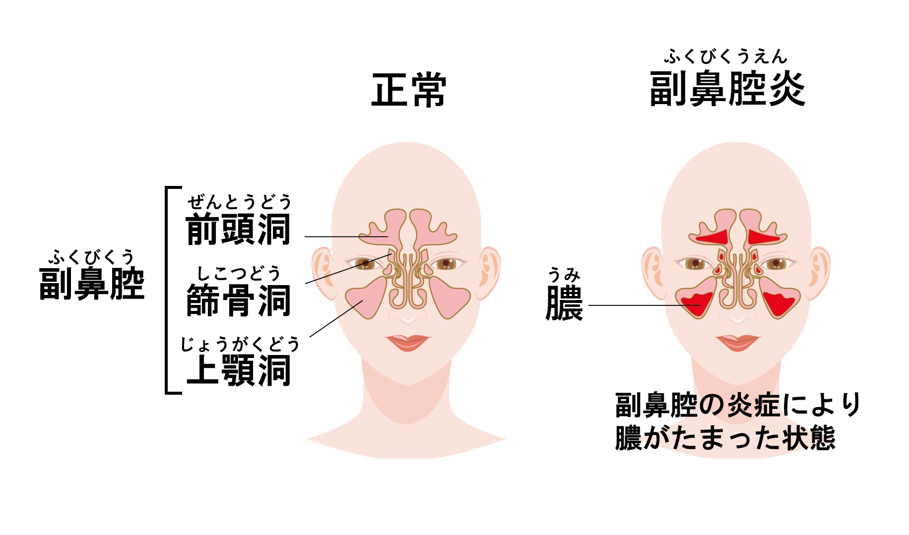 副鼻腔炎比較イラスト